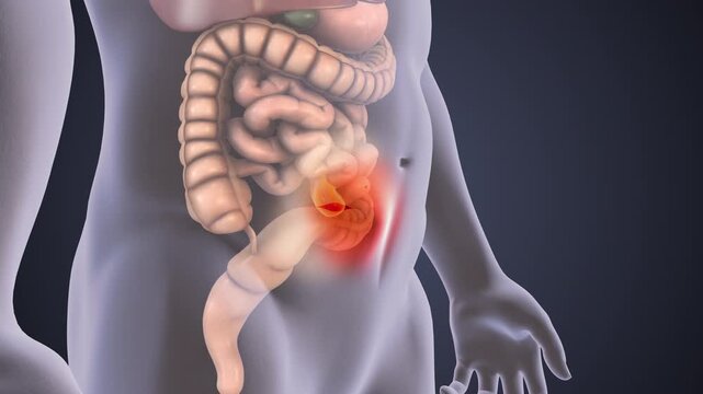 3D Animation Showing Formation of Abdominal Hernia