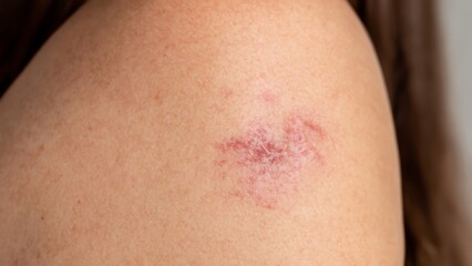 Fototapeta premium Closeup of Bruises on Skin