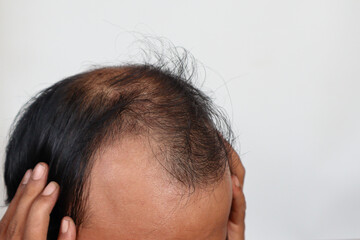 Fototapeta premium Asian Man with hair loss problems closeup, isolated on white background. Alopecia balding hairs on man scalp. Person hand pointing his bald head. Scratching his head. Baldness. Depression, stress.