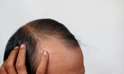 Fototapeta premium Asian Man with hair loss problems closeup, isolated on white background. Alopecia balding hairs on man scalp. Person hand pointing his bald head. Scratching his head. Baldness. Depression, stress.
