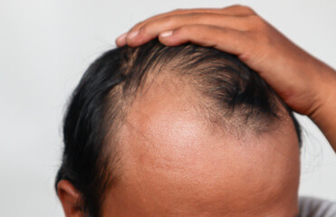 Fototapeta premium Asian Man with hair loss problems closeup, isolated on white background. Alopecia balding hairs on man scalp. Person hand pointing his bald head. Scratching his head. Baldness. Depression, stress.