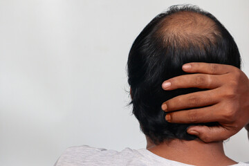 Fototapeta premium Asian Man with hair loss problems closeup, isolated on white background. Alopecia balding hairs on man scalp. Person hand pointing his bald head. Scratching his head. Baldness. Depression, stress.
