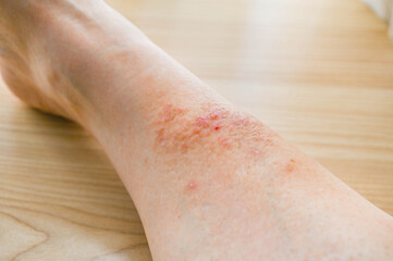 保湿クリームを塗った足の湿疹