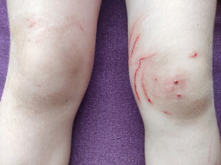 Naklejka premium Child's leg injury with deep scratches on the skin, close-up. The kid hurt his knee when he fell in the rose bush. The knees are red with wounds and scratches on the skin.