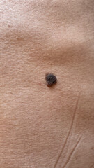 Close-up of Pigmented Skin Mole or Wart on Human Body