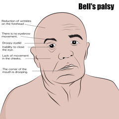 Bell's Palsy, a neurological disorder.