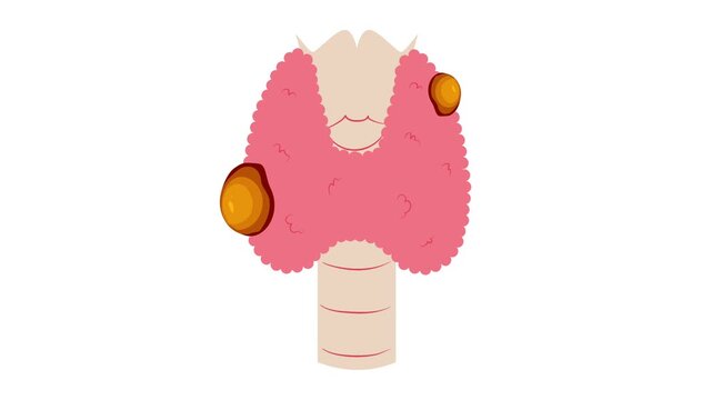 Thyroid disease illustration animation. Thyroid Cancer. World thyroid day