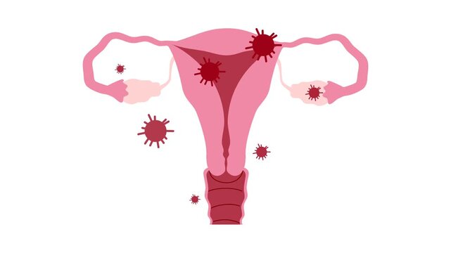 Ovarian cancer illustration. World ovarian cancer day concept	