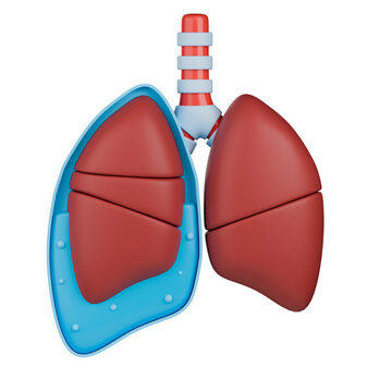 Transudative pleural effusion 3d illustration. Human lung with fluid accumulation in pleural space.