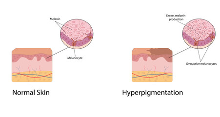 Hyperpigmentation vector illustration