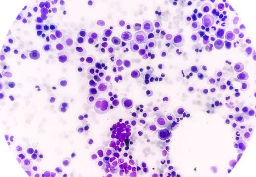 Bone marrow study (BMS): Panmyelosis. Polycythemia Vera, a type of blood and bone marrow cancer. Myeloproliferative Neoplasms (MPNs), CML