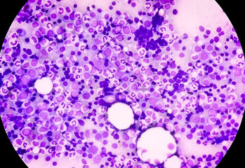 Bone marrow study: Plasma cell dyscrasia. Smoldering or early multiple myeloma (the patient has a...
