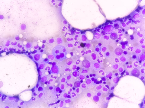 Bone marrow study: Plasma cell dyscrasia. Smoldering or early multiple myeloma (the patient has a history of plasmacytoma at the dorsal vertebral level -L2)