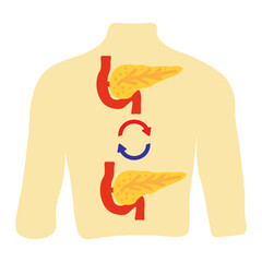 Pancreas Transplant Medical Icon
