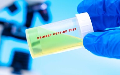 Measures cystine levels in urine to diagnose cystinuria, a