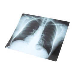 A grayscale chest X-ray, slightly angled, shows lungs, ribs, and spine; subtle shadowing is visible