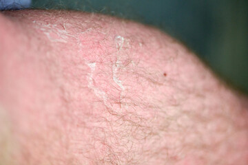 Close-up of sunburnt skin showing desquamation and redness. Soft lighting highlights peeling and...