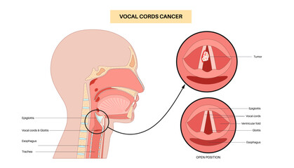 Vocal cord cancer medical poster