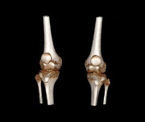 Normal knee CT scan 