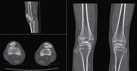 Normal knee CT scan 