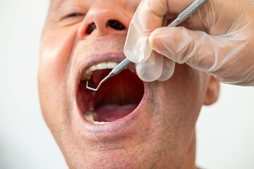 patient opens wide dentist examines teeth with dental specialized tool, routine oral care, Close-up...
