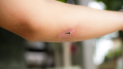 Naklejka premium A raw, open wound on a person's elbow, highlighting the pain and process of healing from an injury