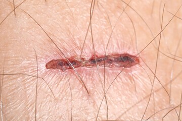 Macro view of damaged human skin as background