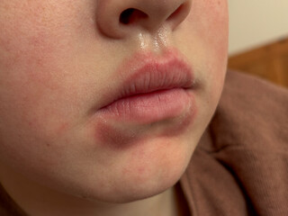 Macro shot of human lips with visible redness and skin irritation, useful for illustrating dermatological issues, allergy, or infection symptoms.