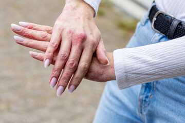 Skin conditions affecting hands with redness and irritation in outdoor setting during daytime hours