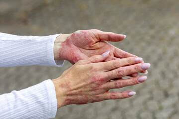 Hands affected by eczema and psoriasis displayed in an outdoor setting with textured background