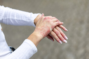 Skin inflammation and discomfort from eczema and psoriasis on hands during daytime outside