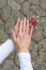 Hands with eczema and psoriasis resting together on a paved surface in an outdoor setting during daylight