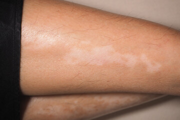 Fototapeta premium Skin condition showing light patches on the arm in detail