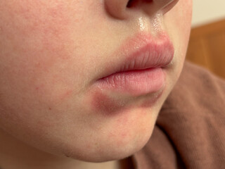 Macro shot of human lips with visible redness and skin irritation, useful for illustrating dermatological issues, allergy, or infection symptoms.