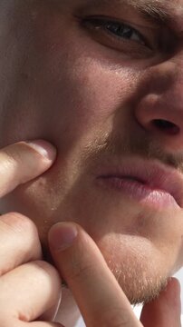 A young man with a pimple on his face.
Man touching a rash on his face.
Facial care. Close-up of a skin infection.
Pimples, face, rash, redness, diathesis