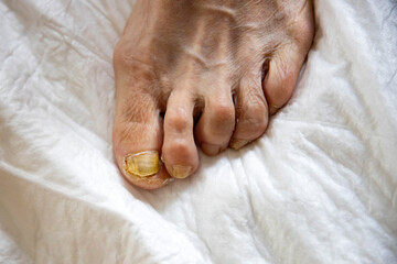 Toenail fungus on foot. © erika8213