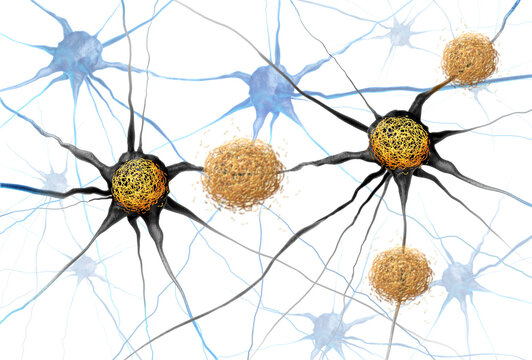 Amyloid Beta And Tau tangles concept as abnormal clusters of protein fragments that accumulate between nerve cells and inside neuron cells in the brain resulting in degenerative disease as Alzheimers.