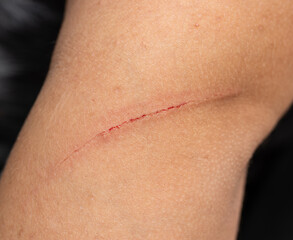 A person's arm has a red scar that is healing