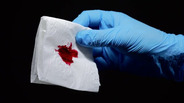 Blood on toilet paper.
A doctor wearing sterile gloves holds a tissue stained with blood.
Blood during a bowel movement.
Hemorrhoidal inflammation and anal pain.
Blood, pain, medicine, urology