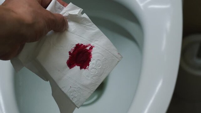 Close-up of blood on toilet paper.
Treatment of hemorrhoids in men.
Inflammation of the anus due to hemorrhoids and pain in the anus.
Bloody discharge from the anus.
Health, male, paper, wipe, hemorrh