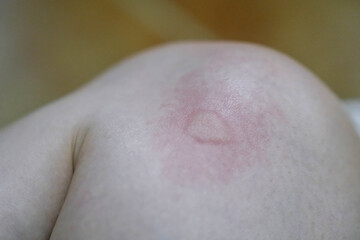 Close-up of a Large Mosquito Bite on a Human Thigh