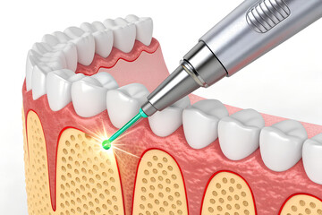Advanced Laser Dentistry Procedure Targeting Oral Tissues