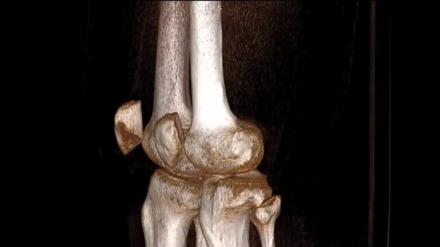 3D CT Scan of Knee Joint with Rotating Image and 2D Sagittal View showing a clear tibia fracture. This advanced medical imaging visualization highlights bone structure, alignment, and injury details