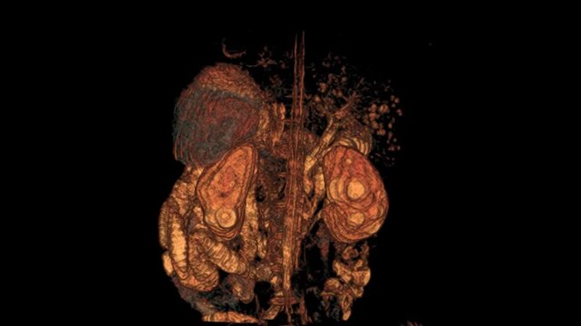 MRCP eT2W SPAIR Coronal VR Movie for advanced medical imaging analysis. High-resolution MRI scan for precise abdominal and biliary system evaluation.