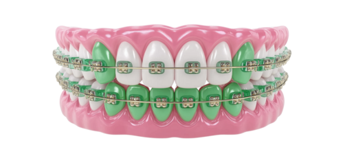 A close-up view of a smiling mouth showing clean white teeth with metal dental braces. The braces feature shiny silver brackets and connecting wires, reflecting professional orthodontic care. The imag