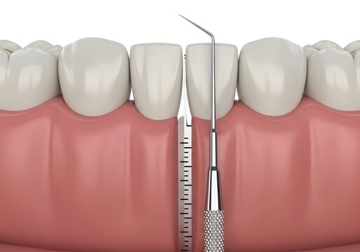 A dental probe measuring the gum recession between teeth in a close up view of the mouth area