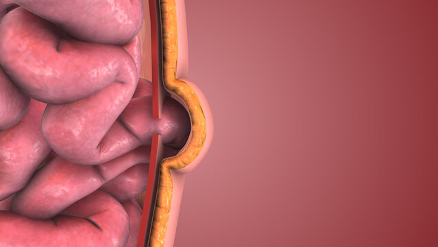 3D Medical Concept of Abdominal Hernia Development