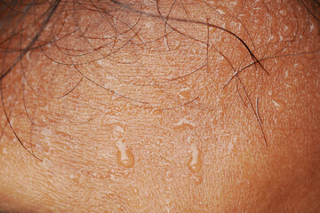 Fototapeta premium Skin shows droplets of sweat on forehead in warm weather conditions