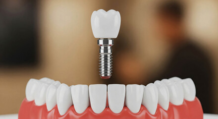 Dental Implant and Crown Assembly Modern Dentistry for a Perfect Smile