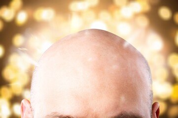 Methods for hair transplantation. Man alopecia hair loss problem
